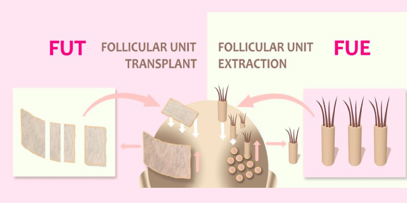 the-difference-between-fue-and-fut